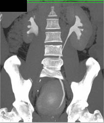 Retroperitoneal Fibrosis - CTisus CT Scan
