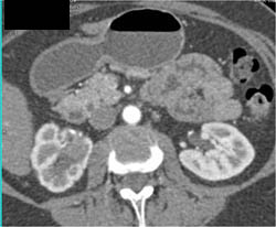 Scarring Right Kidney With Small Renal Carcinoma - CTisus CT Scan