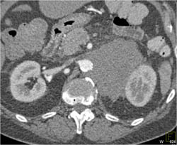 Primary Adrenal Lymphoma Involves the Left Kidney - CTisus CT Scan