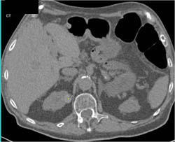 High Density Right Renal Cyst - CTisus CT Scan