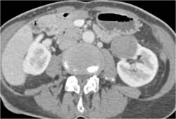 Renal Cell Carcinoma - CTisus CT Scan