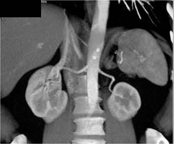 Partial Duplication of the Left Collecting System - Kidney Case Studies ...