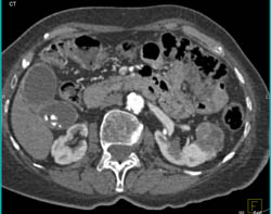 Renal Cell Carcinoma - CTisus CT Scan