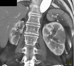 Renal Cell Carcinoma - CTisus CT Scan