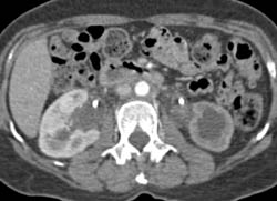 Retroperitoneal Fibrosis - CTisus CT Scan