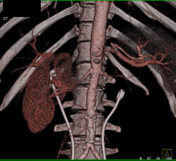 Retroperitoneal Fibrosis - CTisus CT Scan
