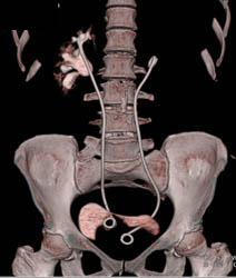 Retroperitoneal Fibrosis - CTisus CT Scan