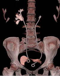 Retroperitoneal Fibrosis - CTisus CT Scan