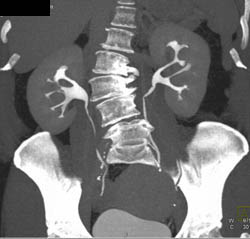 Normal CT Urogram - CTisus CT Scan