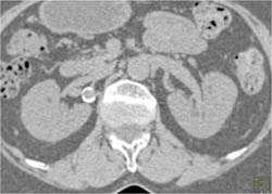 Right Renal Artery Aneurysm - CTisus CT Scan
