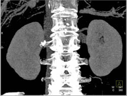 Right Renal Artery Aneurysm - CTisus CT Scan