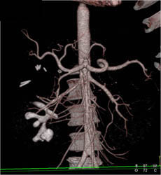 Staghorn Calculus - CTisus CT Scan