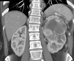 Renal Cell Carcinoma - CTisus CT Scan