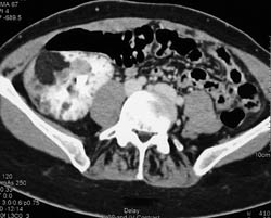 Renal Cell Carcinoma - CTisus CT Scan