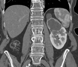 Obstructed Left Upper Pole By Central Transitional Cell Cancer (TCC) - See Full Sequence of Images to Find Tumor - CTisus CT Scan