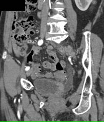 Bladder Cancer - CTisus CT Scan