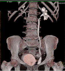 Bladder Cancer - CTisus CT Scan