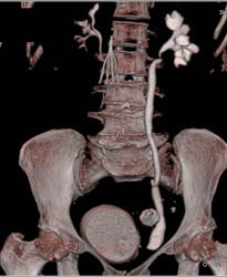 Bladder Cancer - CTisus CT Scan