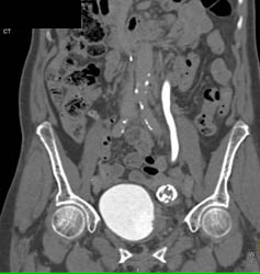 Bladder Cancer - CTisus CT Scan