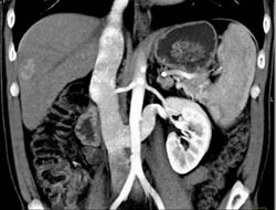 Retroaortic Renal Vein - CTisus CT Scan