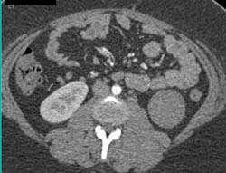 Cystic Left Renal Cell Carcinoma (RCC) - CTisus CT Scan