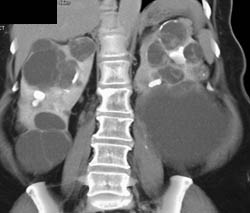 Polycystic Kidney With Complex Cysts - CTisus CT Scan