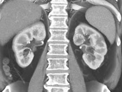 Subtle 2cm Left Renal Cell Carcinoma (RCC) With Multiple Phases and Images to Show Pitfalls of Lesion Detection - CTisus CT Scan