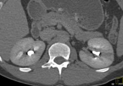 Acute Pyelonephritis - CTisus CT Scan