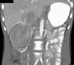 Renal Cell Carcinoma Invades the Inferior Vena Cava (IVC) - CTisus CT Scan