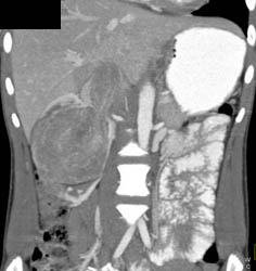 Renal Cell Carcinoma Invades the Inferior Vena Cava (IVC) - CTisus CT Scan