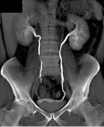 Normal CT Urogram - CTisus CT Scan