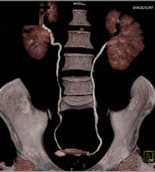 Normal CT Urogram - CTisus CT Scan