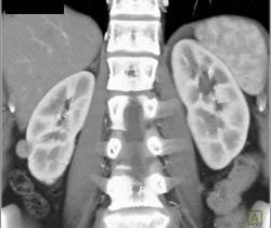 High Density Renal Cyst - CTisus CT Scan