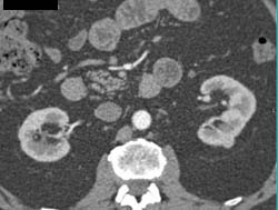 1cm Left Renal Cell Carcinoma (RCC) - CTisus CT Scan