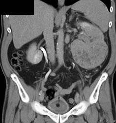 Renal Cell Carcinoma - CTisus CT Scan