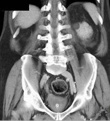 Renal Cyst - CTisus CT Scan