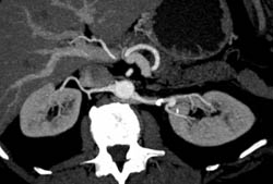Left Renal Artery Aneurysm - CTisus CT Scan