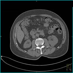 Vascular Renal Cell Carcinoma- With Various Renderings - CTisus CT Scan