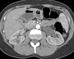 Ectopic Ureterocele With Left Dilated Renal Pelvis - CTisus CT Scan