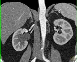 Single Renal Artery on Right Looks Like Multiple Arteries in Various MIP Projections - CTisus CT Scan