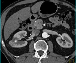 Renal Cell Carcinoma Near Ablation Site - CTisus CT Scan