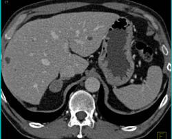 Adrenal Adenoma - CTisus CT Scan