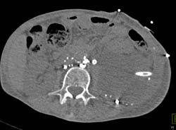 Lymphocele in Renal Fossa S/P Lymphangiogram and Prostate Surgery - CTisus CT Scan