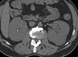 Erdheim-chester Disease Infiltrates the Perirenal Space- Remarkable Case. See Full Sequence of Images - CTisus CT Scan