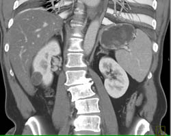 Complex Renal Cyst - CTisus CT Scan