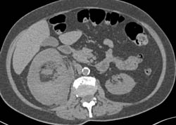 Renal Angiomyolipoma (AML) With Spontaneous Bleed - CTisus CT Scan