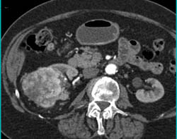 Hypervascular Renal Cell Carcinoma - CTisus CT Scan