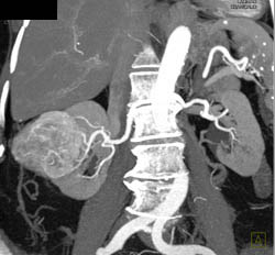 Hypervascular Renal Cell Carcinoma - CTisus CT Scan