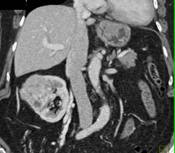 Hypervascular Renal Cell Carcinoma - CTisus CT Scan
