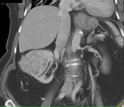 Hypervascular Renal Cell Carcinoma - CTisus CT Scan